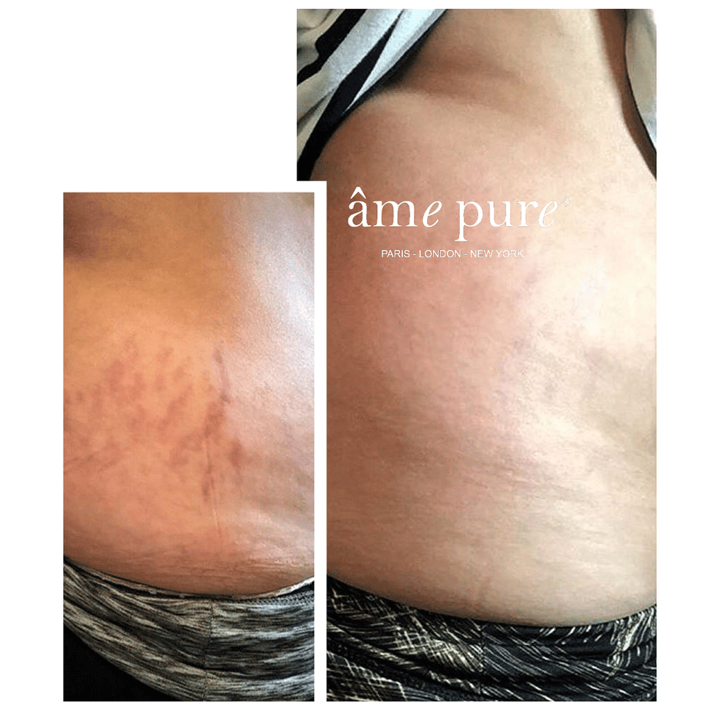 Intensive Stretch Marks Eraser âme pure –