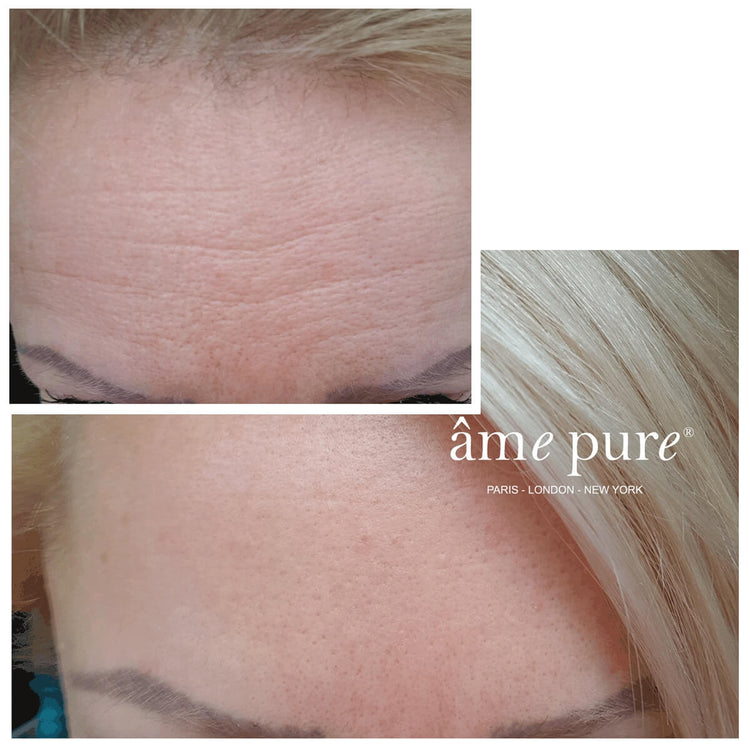 WrinklEraser™ BASIC | 2 par 1 cenu